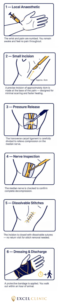 diagram of carpal tunnel surgery steps at excel clinic dublin