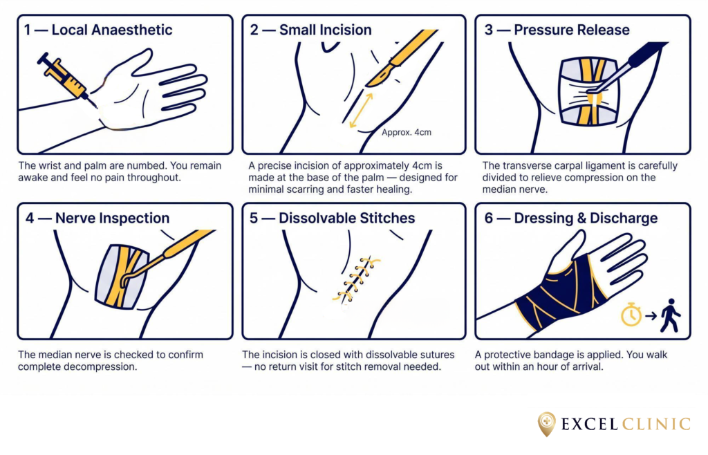 diagram of carpal tunnel surgery steps at excel clinic dublin