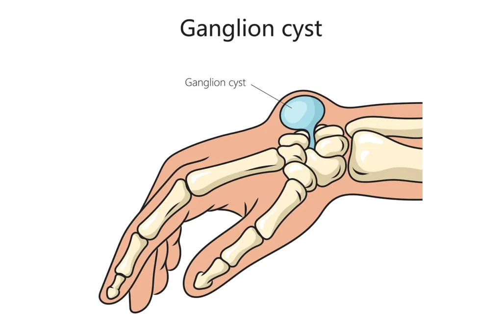 diagram of ganglion cyst in hand - Excel Clinic Dublin