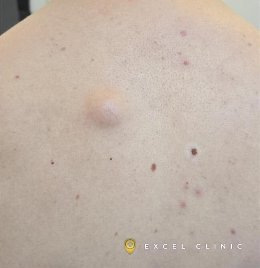 Skin Cyst on thigh