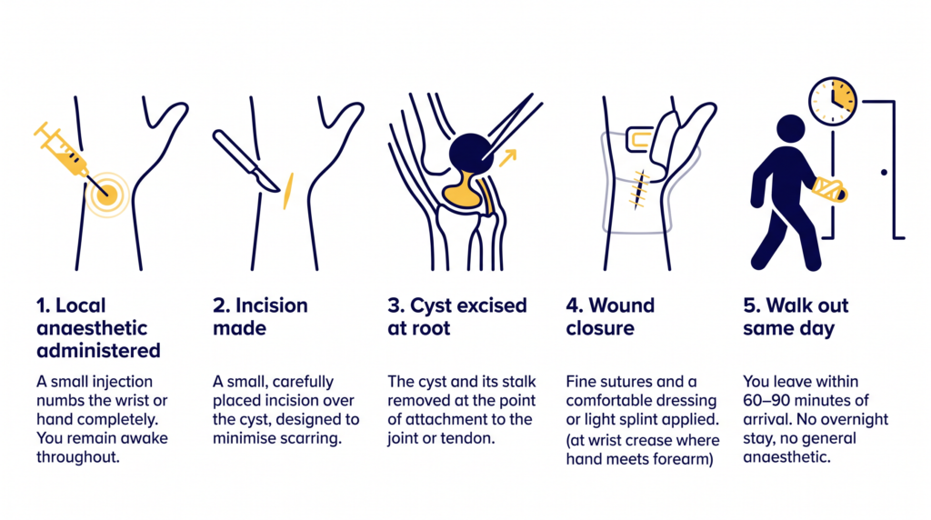 Diagram illustrating 5 steps of ganglion cyst removal from hand - Excel Clinic