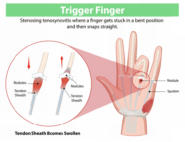 trigger finger diagram - excel clinic