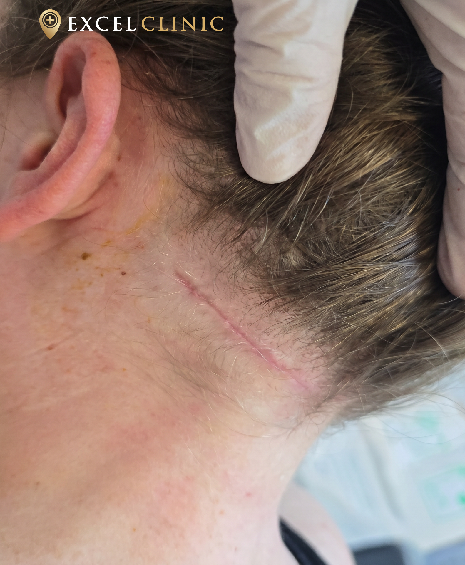 lipoma on back of neck after removal and healing