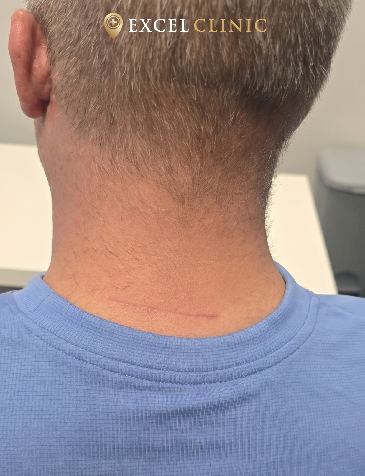large lipoma removal after healing on back of neck