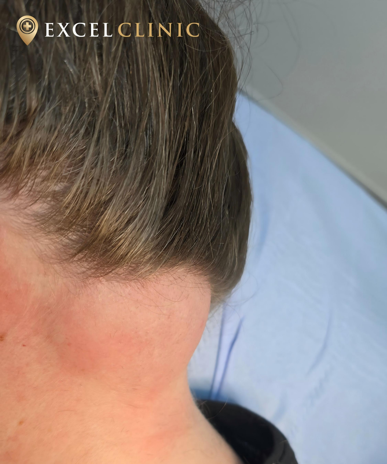 lipoma on back of neck prior to removal