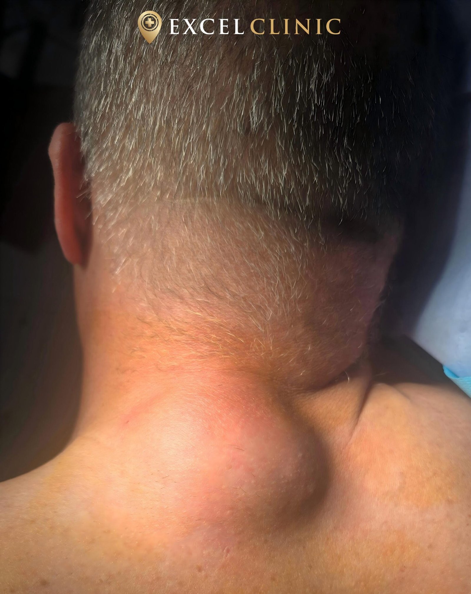 large lipoma on back of neck prior to removal