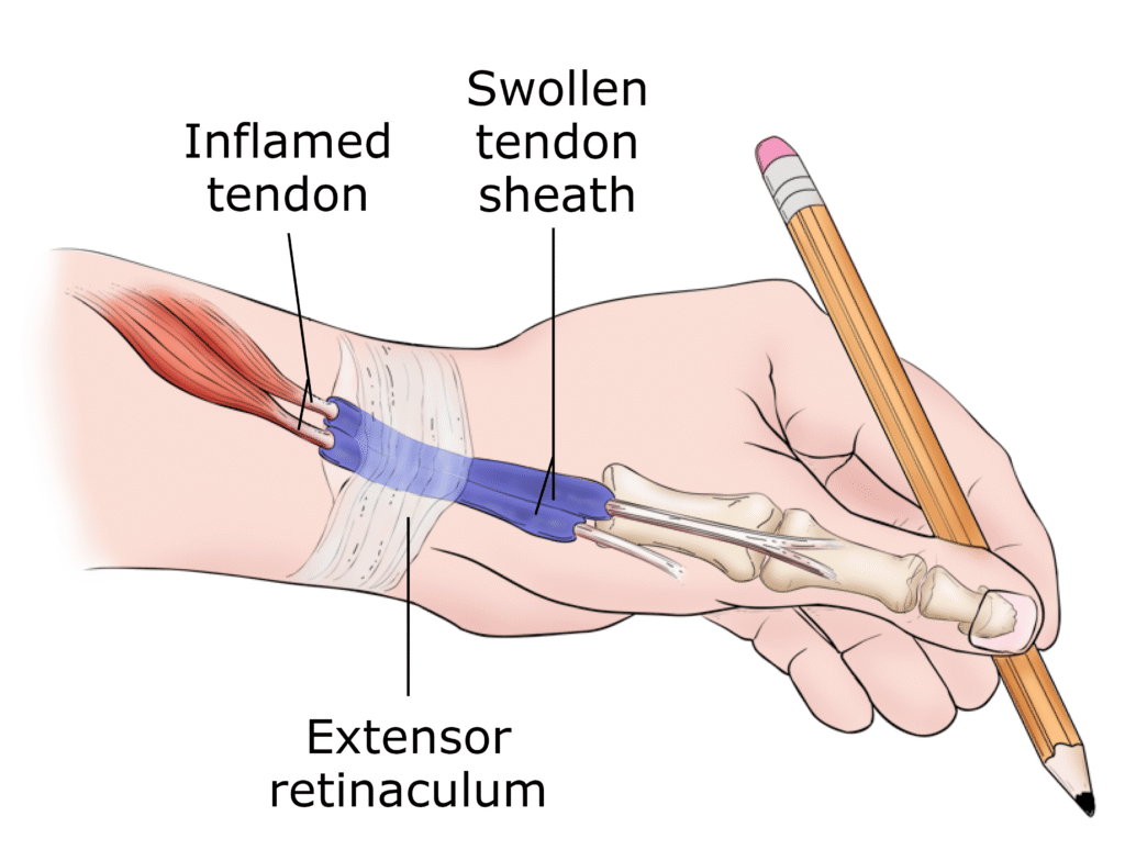 diagram showing de quervian tenosynovitis and inflammed tendon with sheath