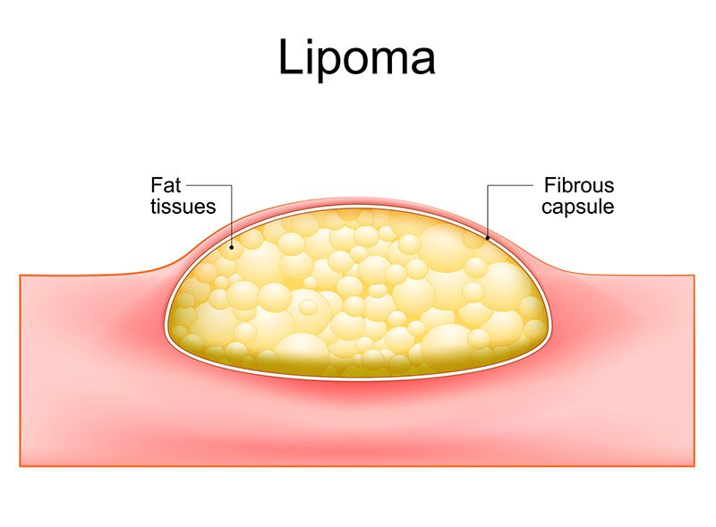 diagram of lipoma - removal possibe at Excel Clinic Dublin