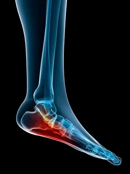 plantar fascitia sole of foot pain